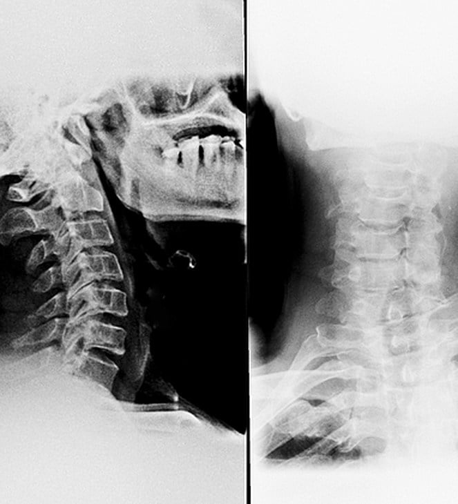 x-ray of a neck car accident injury